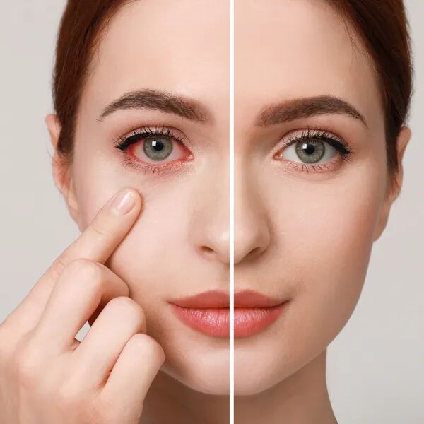 Œil rouge Les bons réflexes à avoir