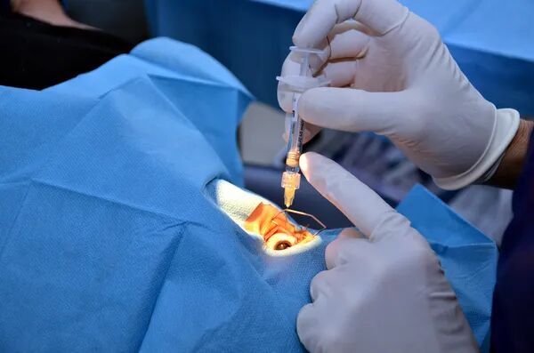 Zoom sur la chirurgie de la cataracte 